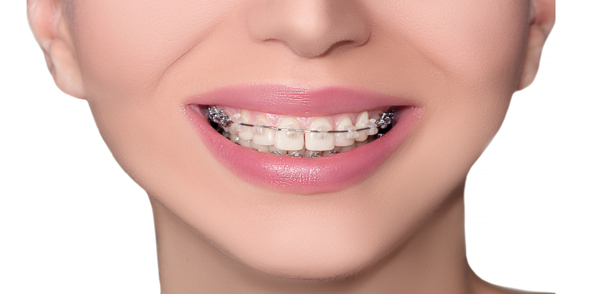 What To Expect With Ceramic Braces: Treatment Process And Care Tips